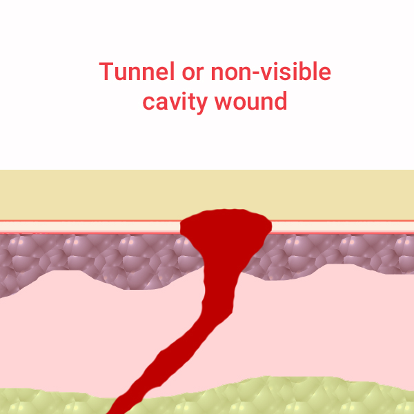 Tunnel Wound